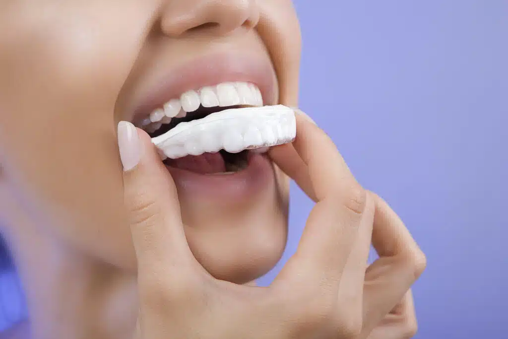 Beautiful Smiling Girl with Tooth Tray