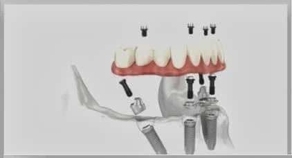 How Many Implants are Required for Full Mouth Dental Implants?