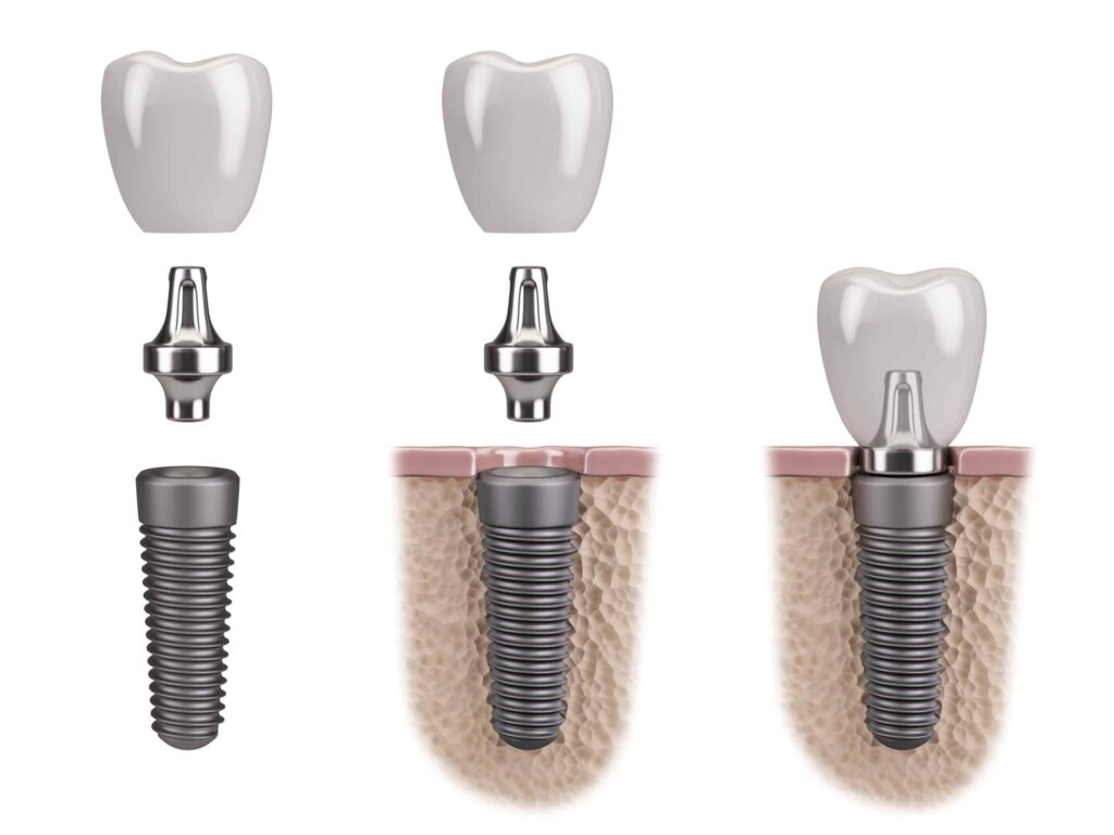 dental implant crown