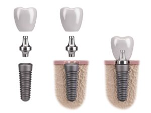 implant crown