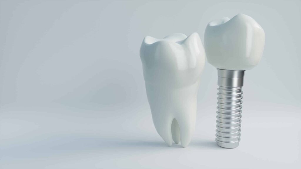 dental implant image with the crown