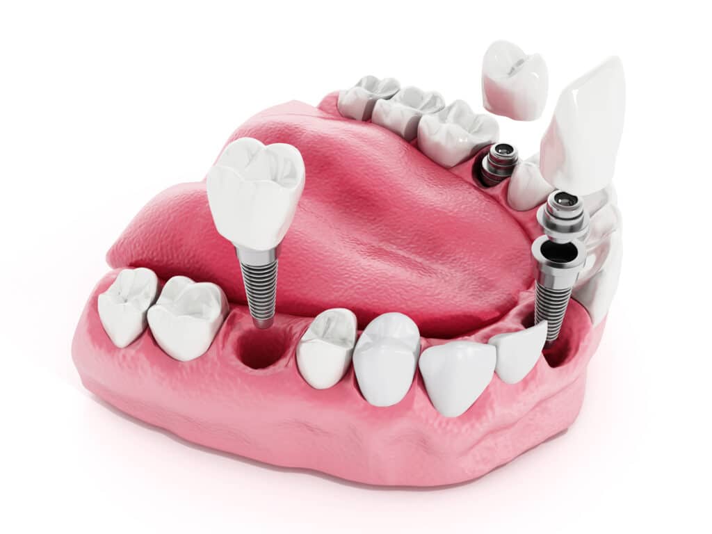 Illustration of teeth showing dental implant structure