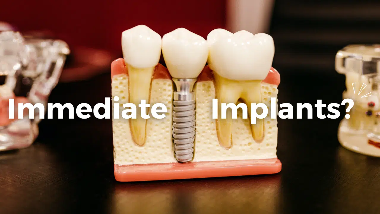 Immediate Implants