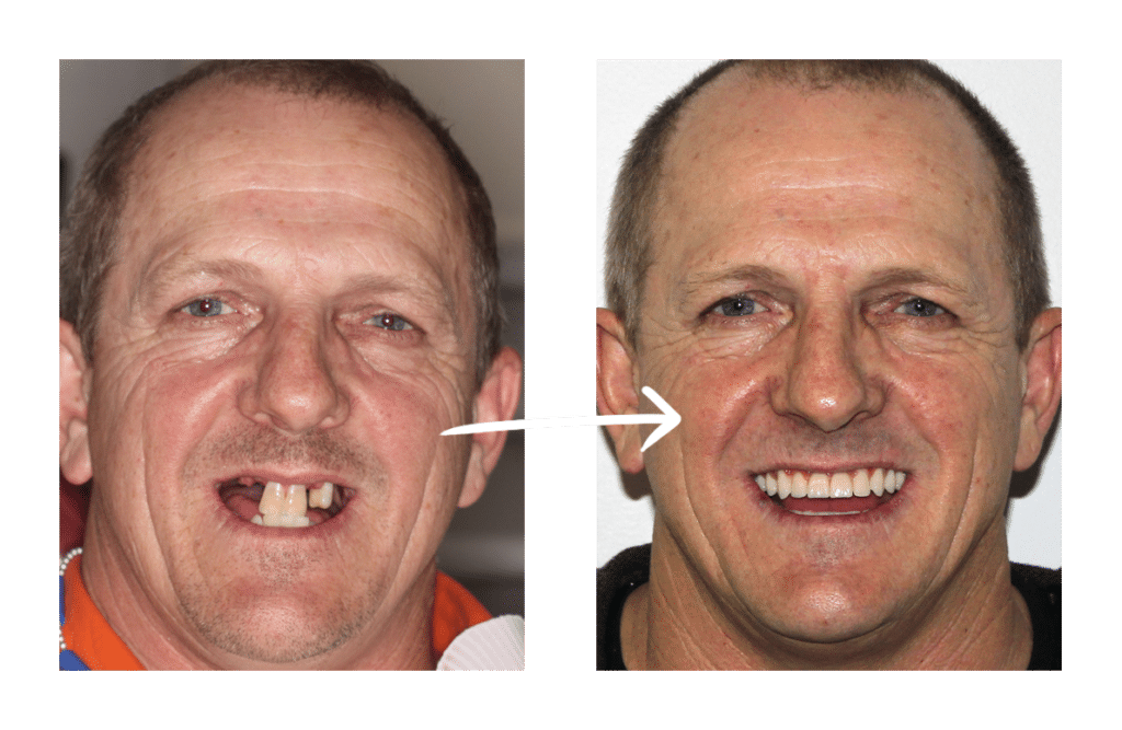 before-after-smiles-1-1024x667