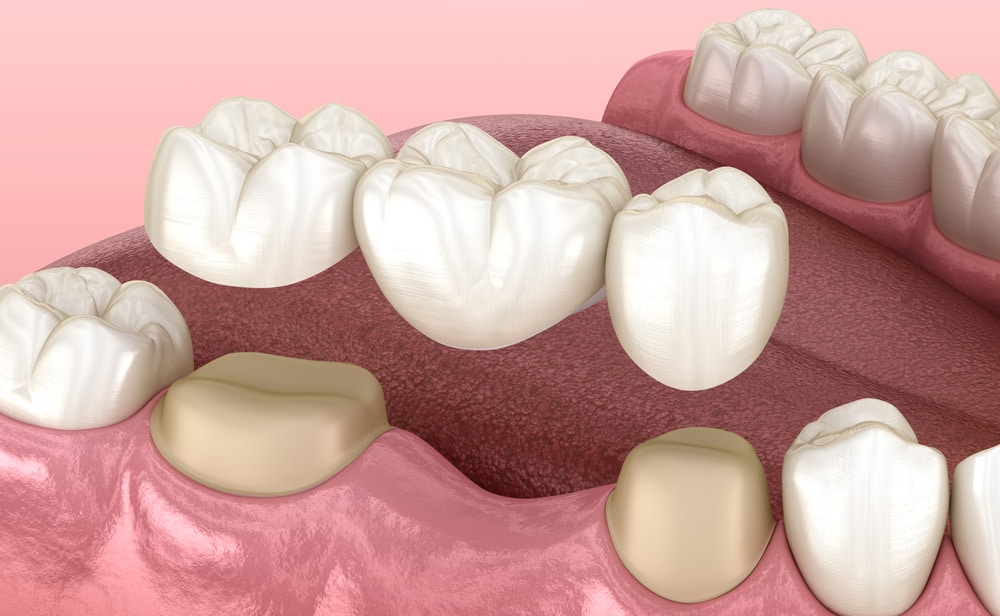 Dental Bridge