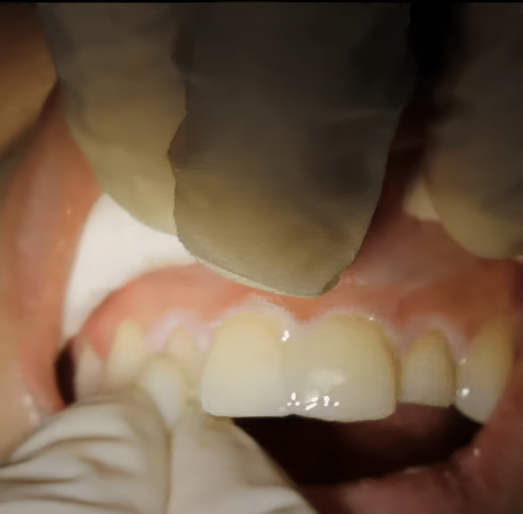 porcelain Veneers