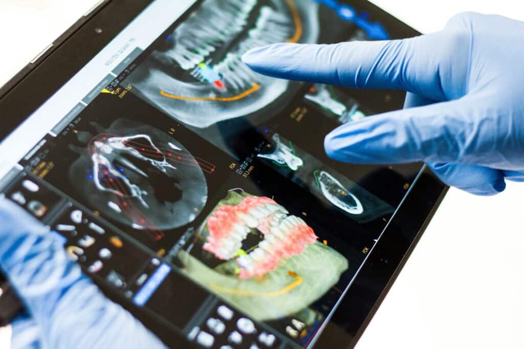 CBCT scan for implant planing