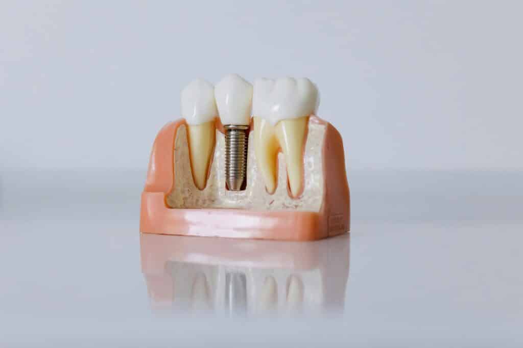 Dental-implant