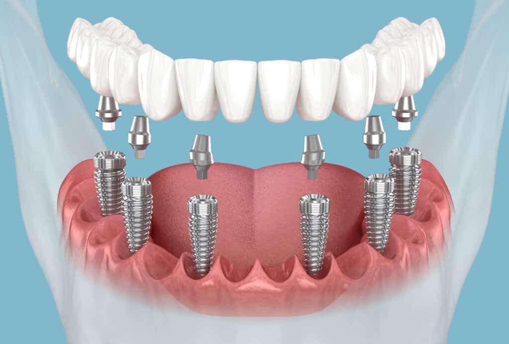 Image of all-on-4 implants components and bridge