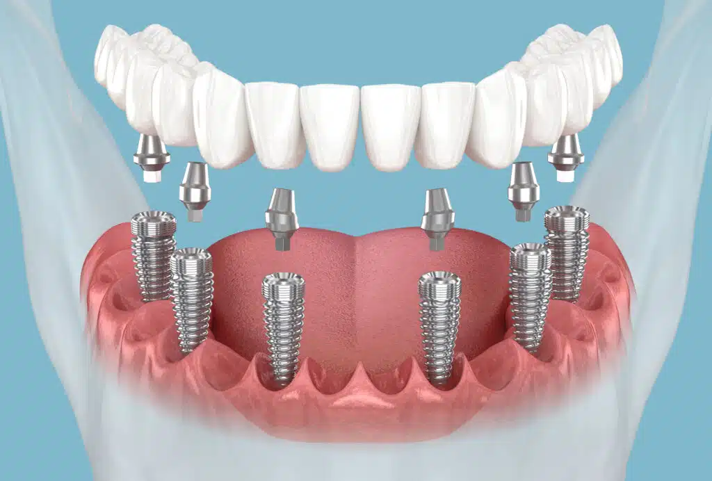 Image of all-on-4 implants components and bridge