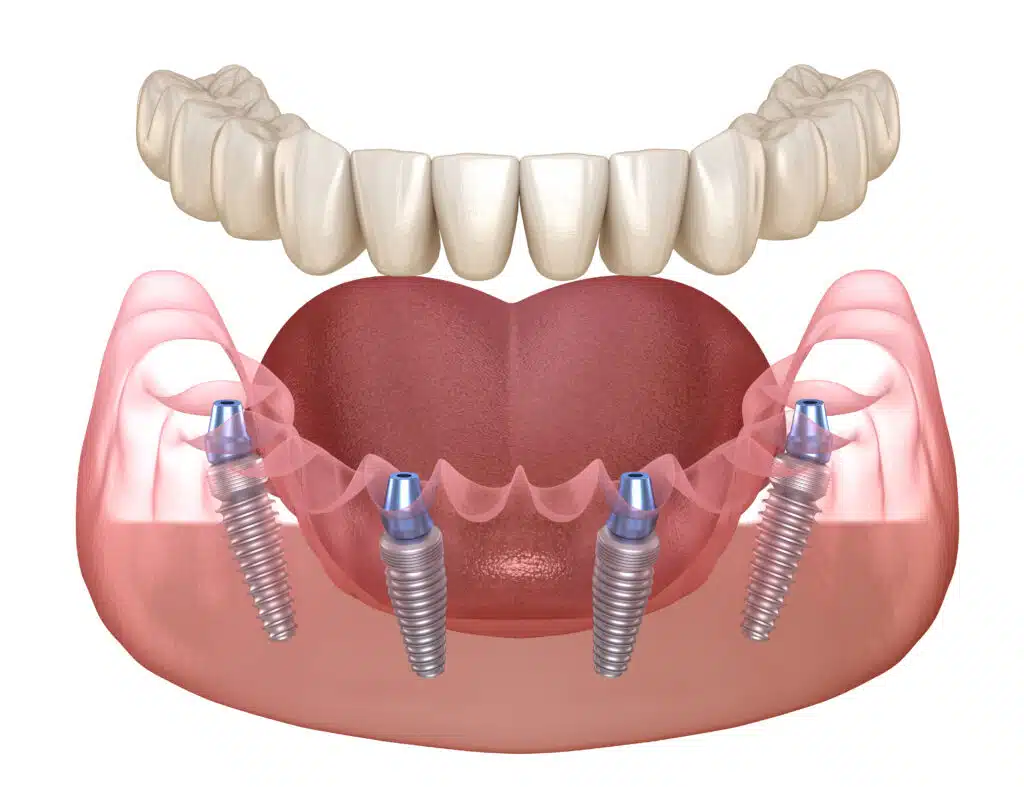 diagram of mouth showing all-on-4 dental implants