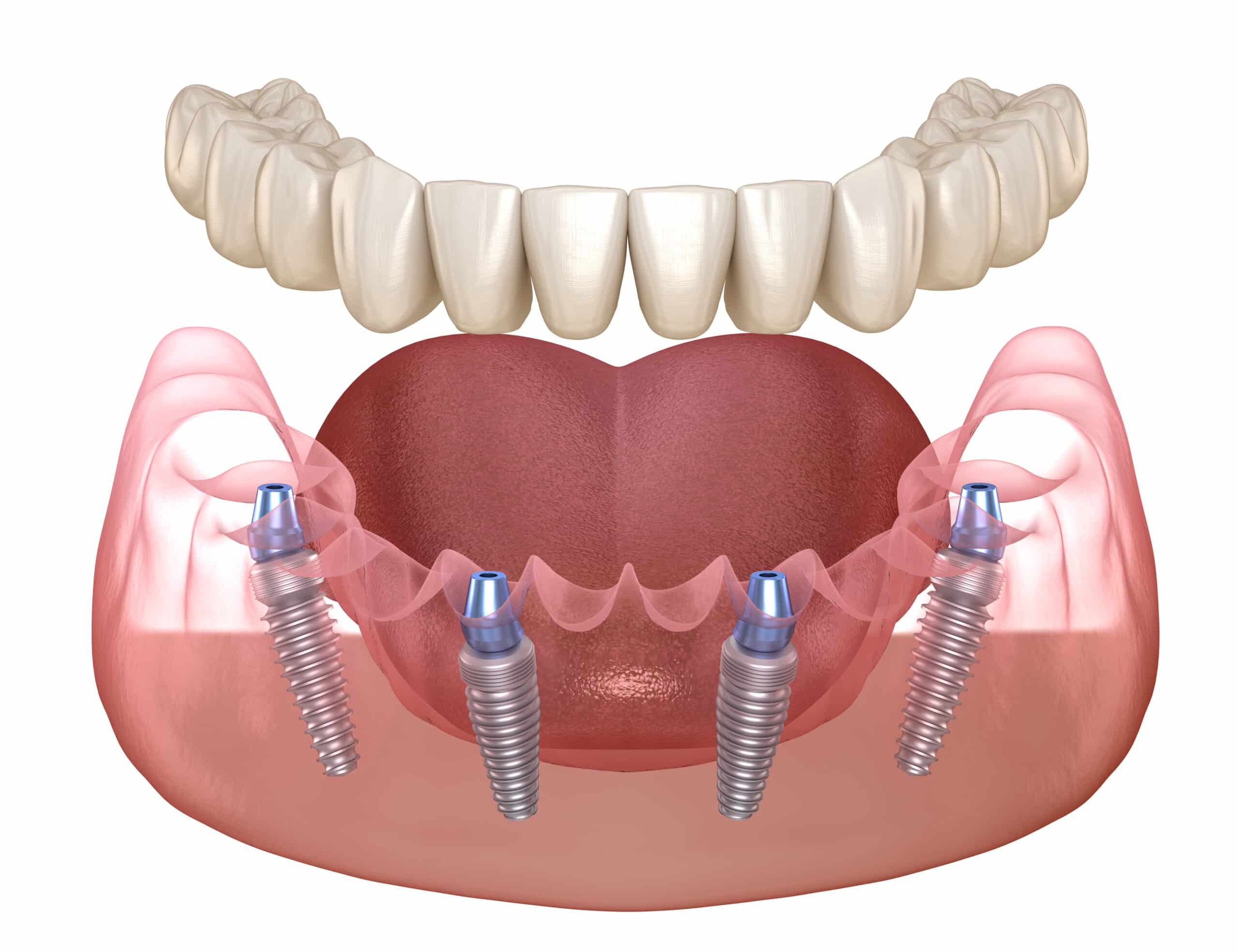 All teeth on 4 implants -showing Process