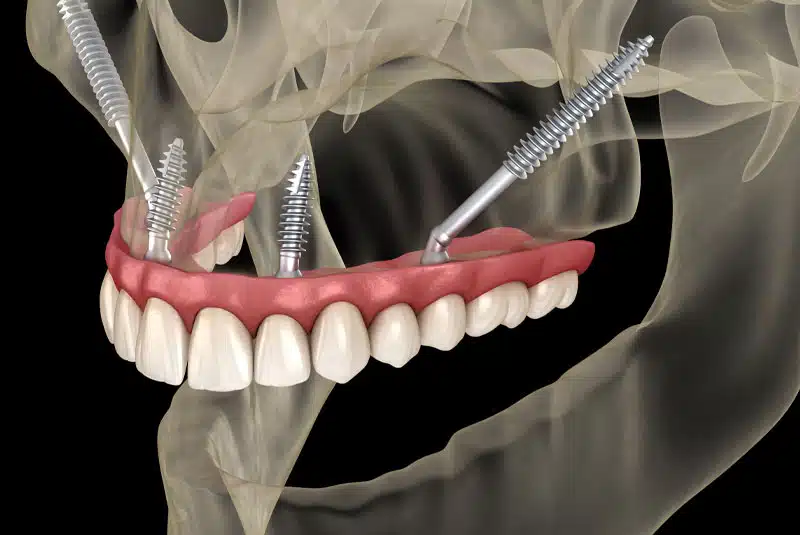 3D image of Zygomatic Implants