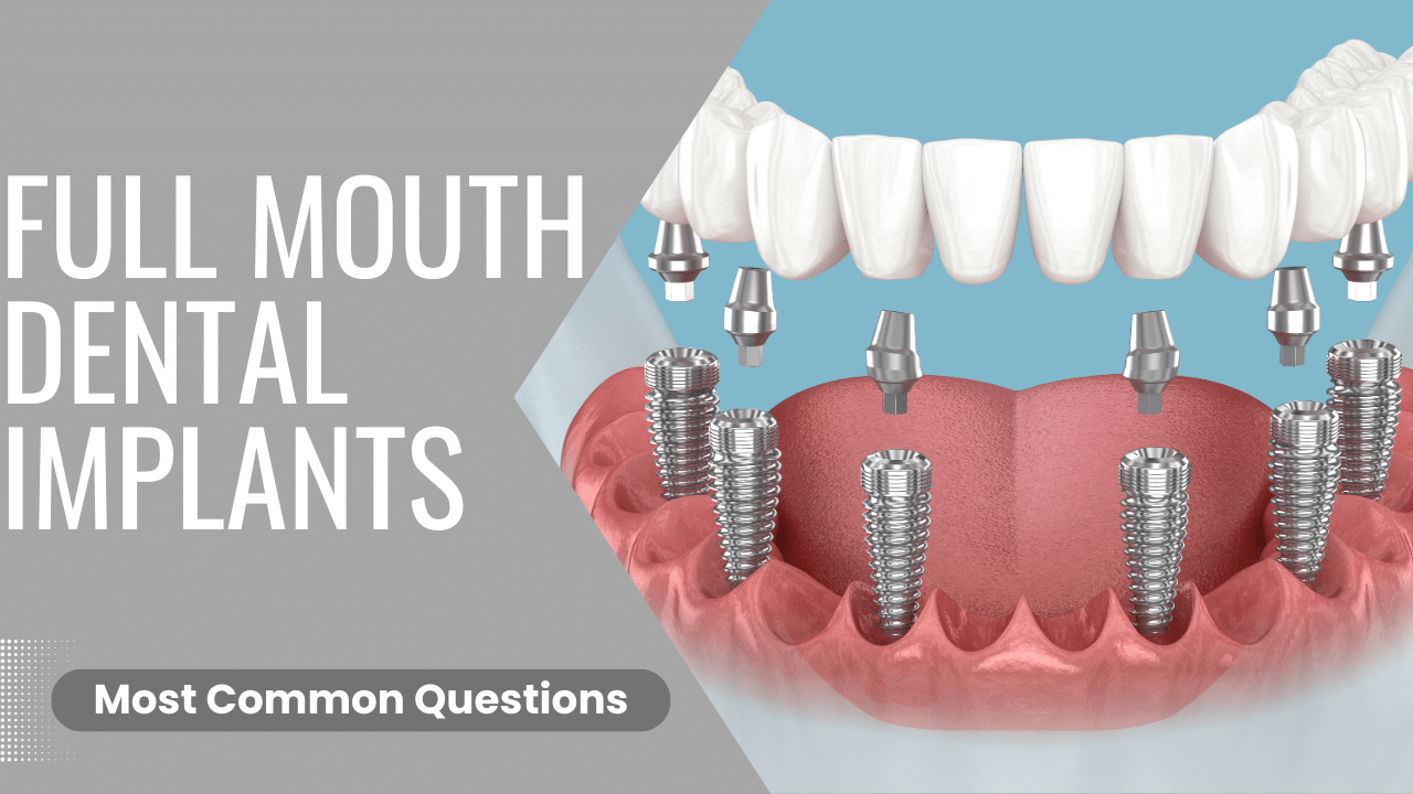 Full mouth dental implants- most common questions