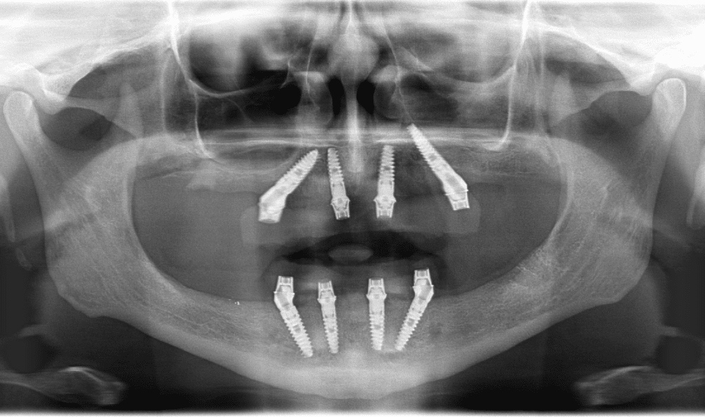 OPG - Dental Implants