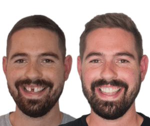 Single tooth replacement with dental implant