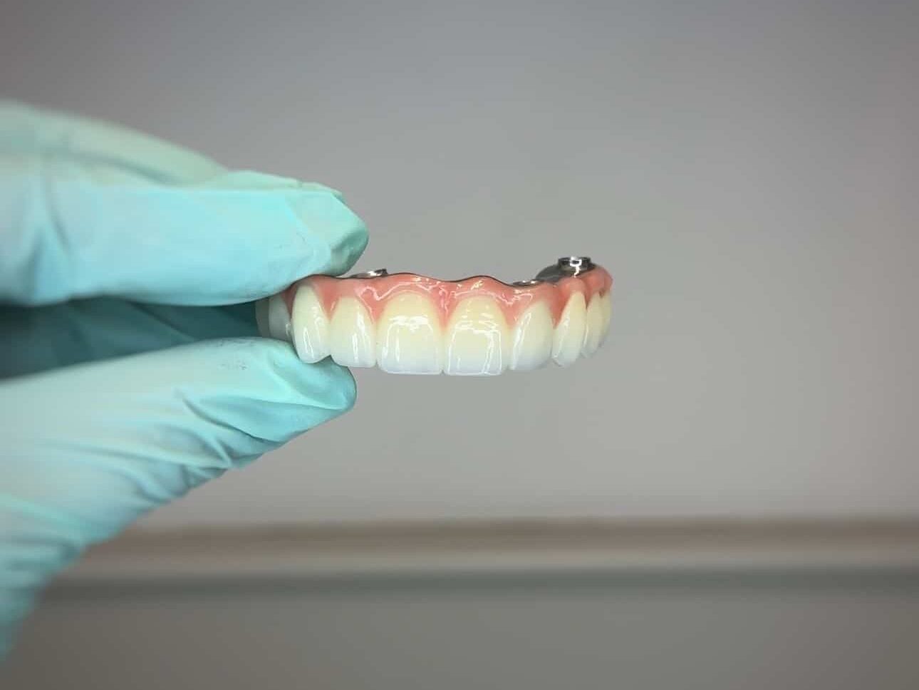 All-on-4 prosthetic teeth