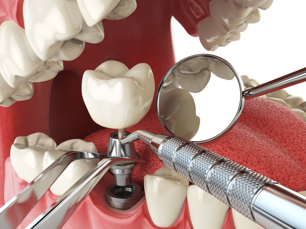Implant