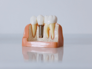 4 implants 
