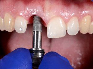 Dental Implant 