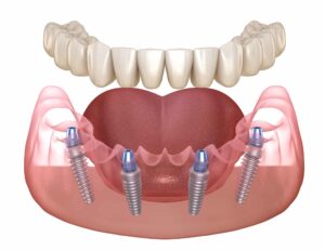 All teeth on 4 implants -Process