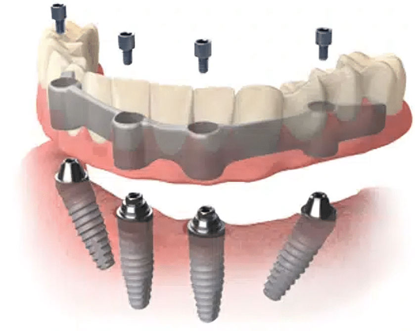 Dental Implants