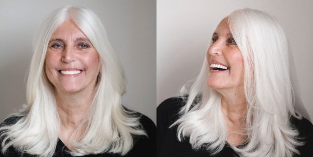 Woman smiling after All-on-4 dental implant treatment showing full upper and lower prosthetic teeth