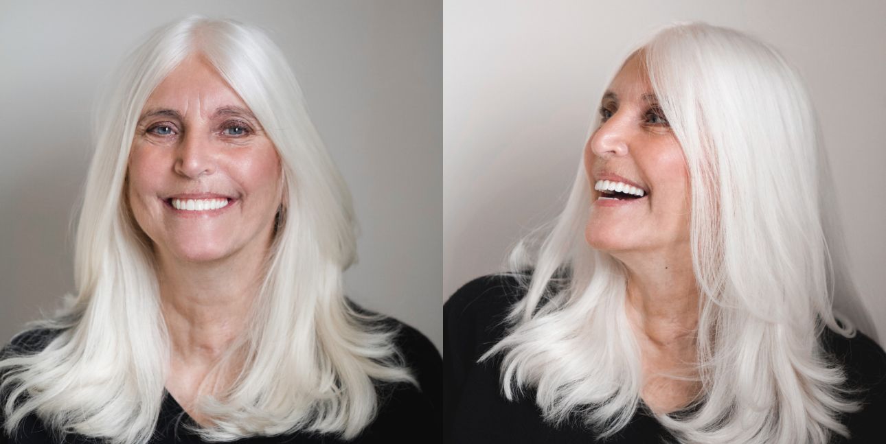 Woman smiling after All-on-4 dental implant treatment showing full upper and lower prosthetic teeth