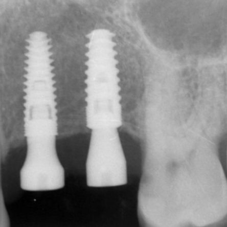 How dental implants work