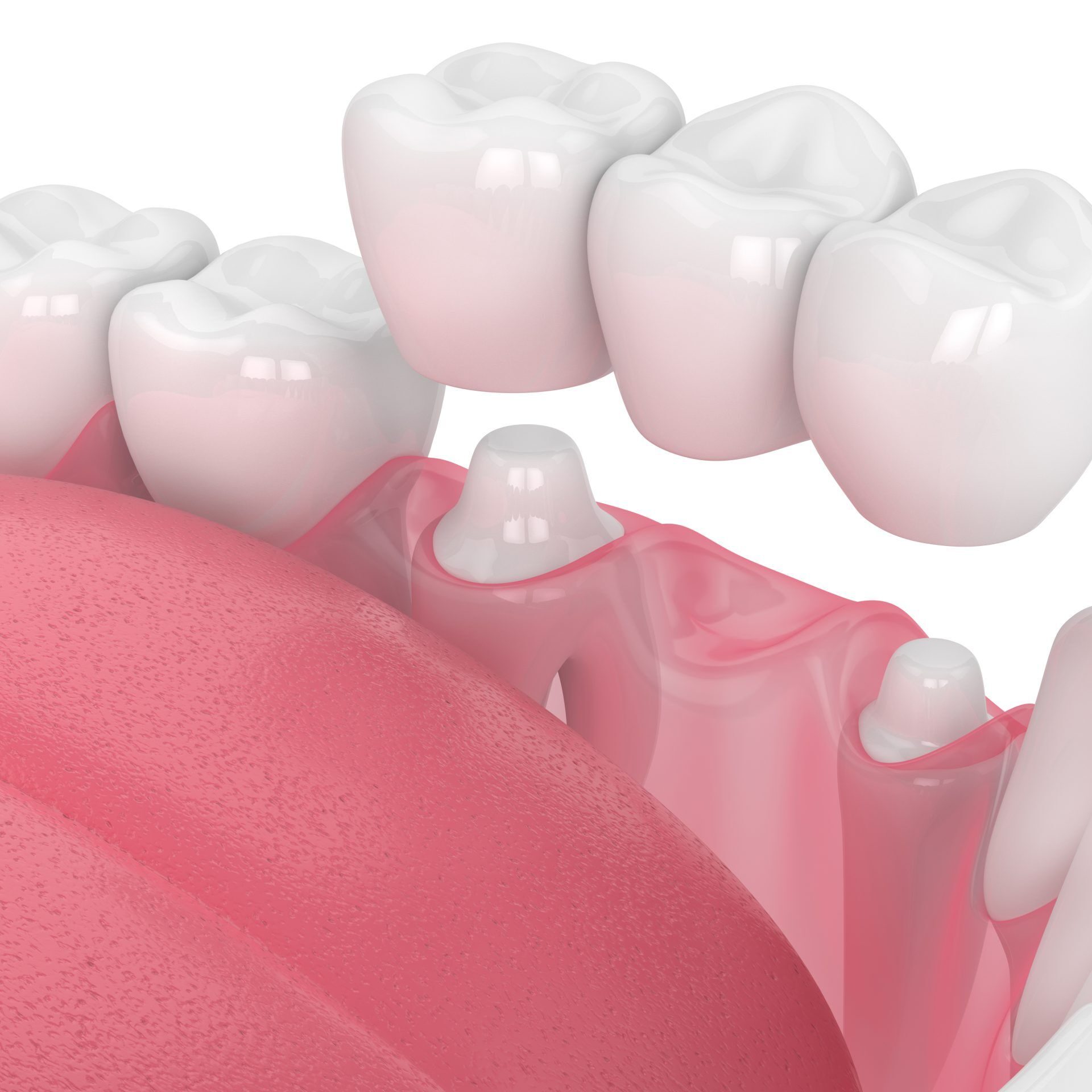 What Are the Benefits of Dental Implants Compared to Dentures?