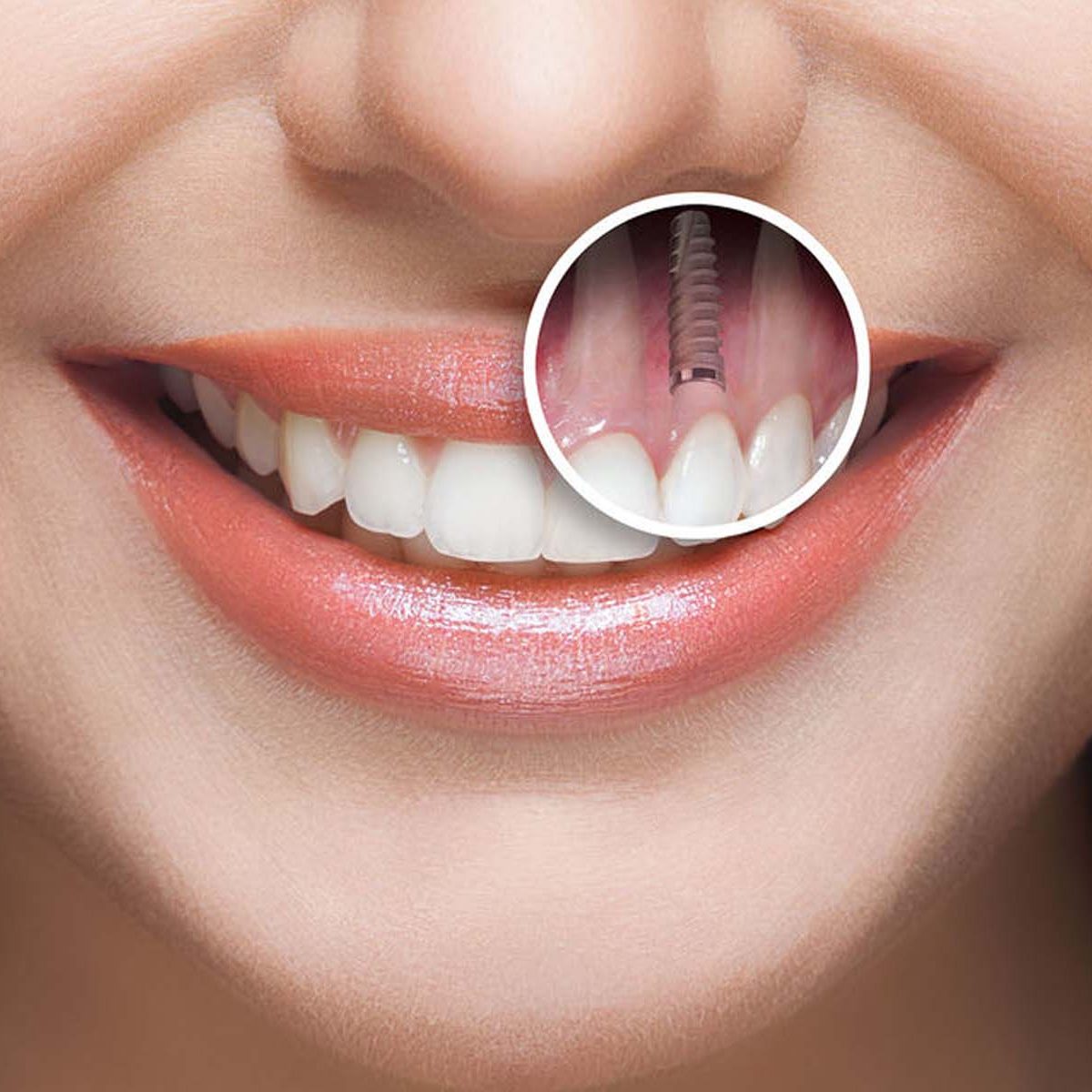 dental implants